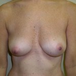 Breast Augmentation Before & After Patient #89