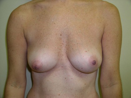 Breast Augmentation Before & After Patient #89