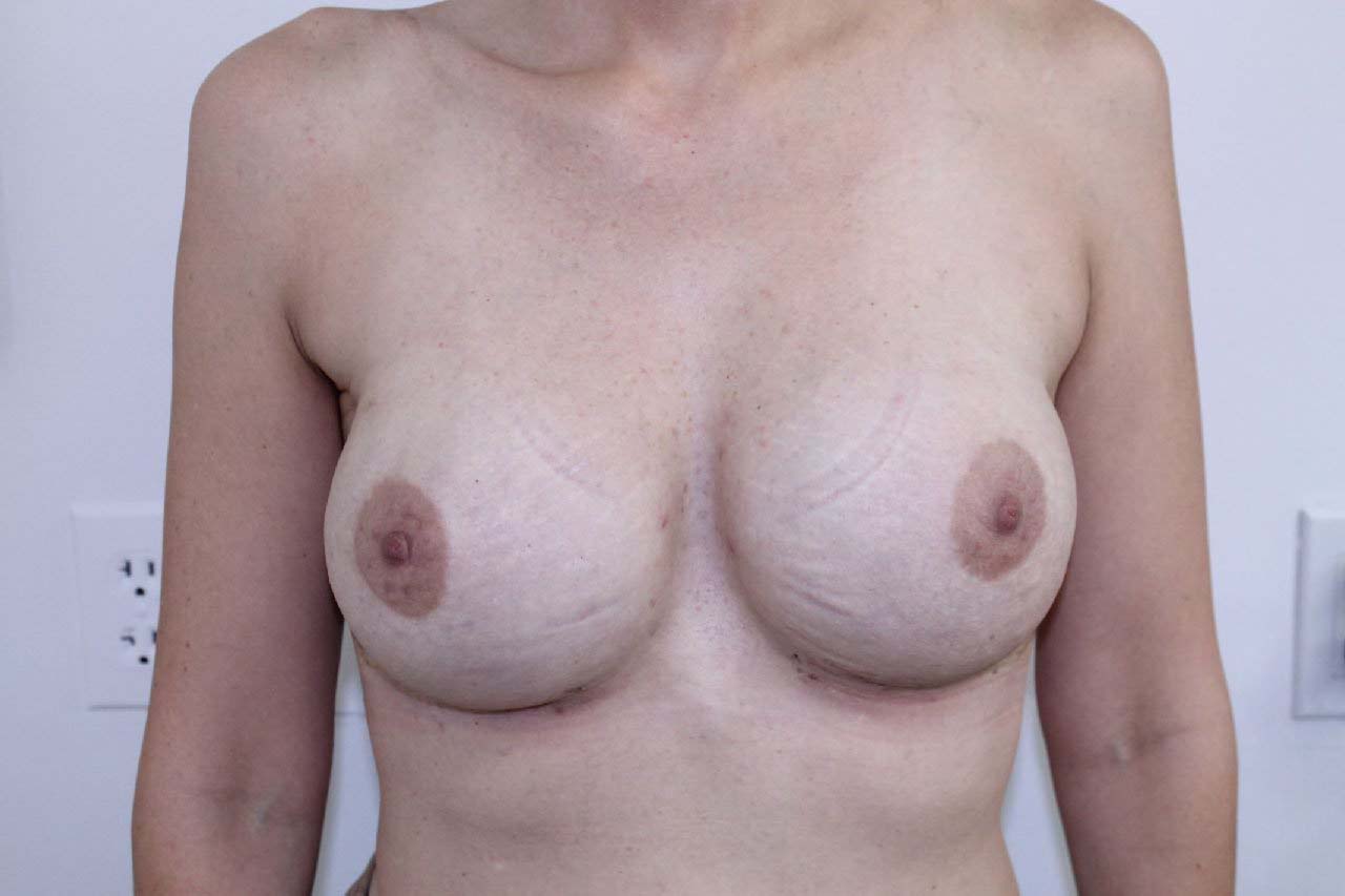 Breast Augmentation Before & After Patient #187