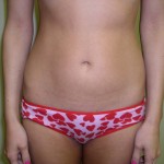Liposuction Before & After Patient #333