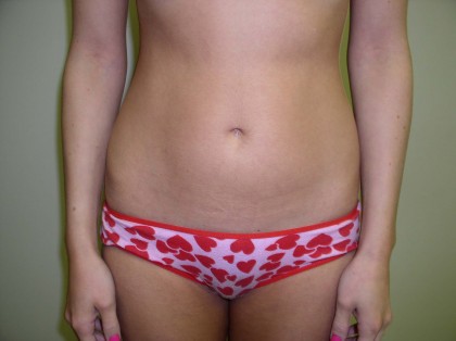 Liposuction Before & After Patient #333