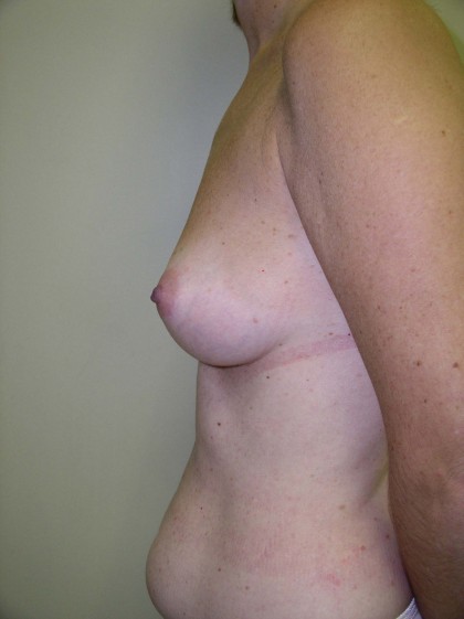 Breast Augmentation Before & After Patient #89