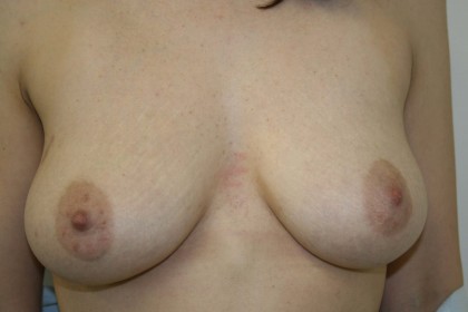 Breast Augmentation Before & After Patient #187