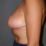 Breast Reduction Before & After Patient #212