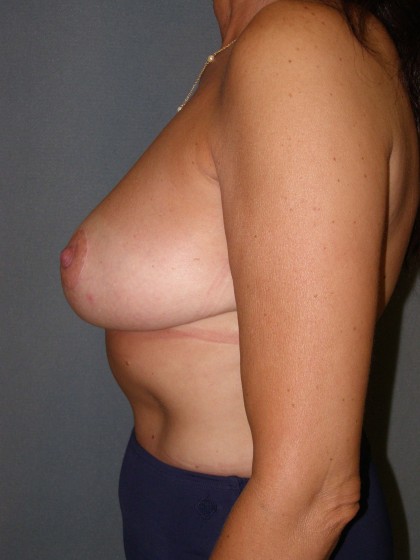 Breast Reduction Before & After Patient #212