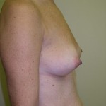 Breast Augmentation Before & After Patient #89