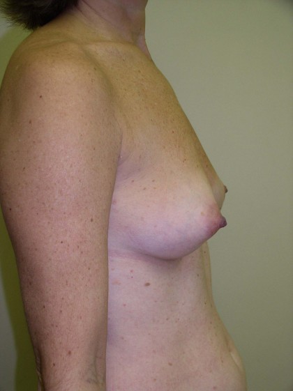 Breast Augmentation Before & After Patient #89