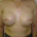 Breast Reconstruction Before & After Patient #190