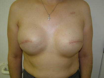 Breast Reconstruction Before & After Patient #190