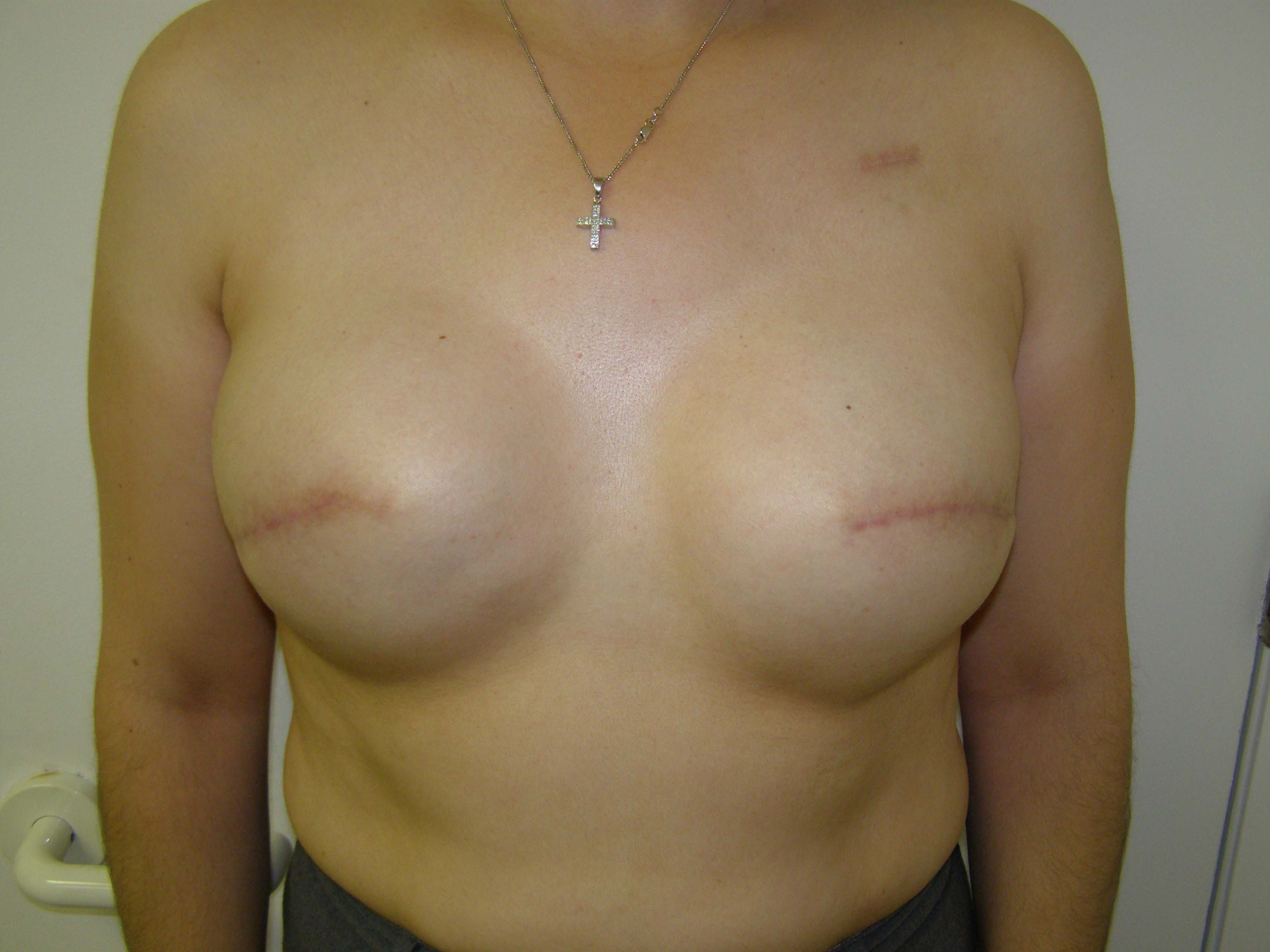 Breast Reconstruction Before & After Patient #190