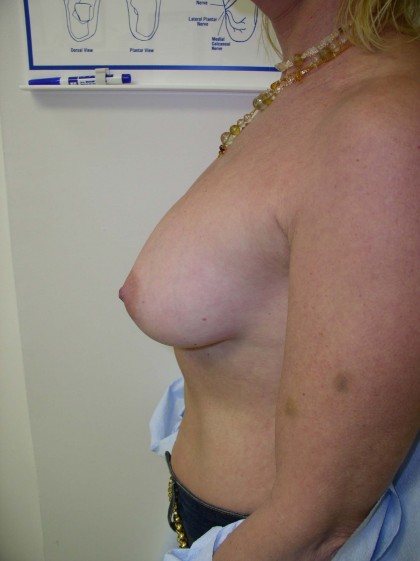 Breast Lift Before & After Patient #166