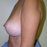 Breast Augmentation Before & After Patient #89