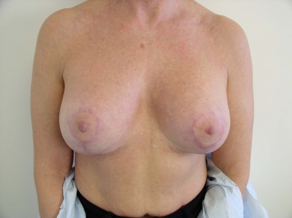 Breast Lift Before & After Patient #166
