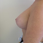 Breast Lift Before & After Patient #166
