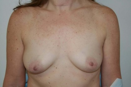 Breast Reconstruction Before & After Patient #193