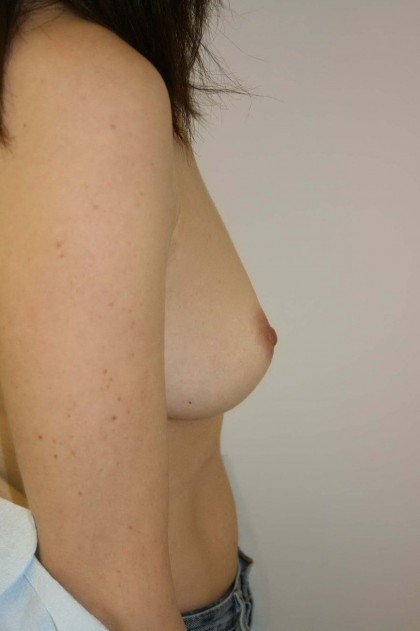 Breast Augmentation Before & After Patient #96