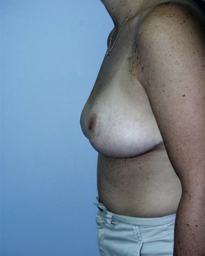 Breast Reduction Before & After Patient #221