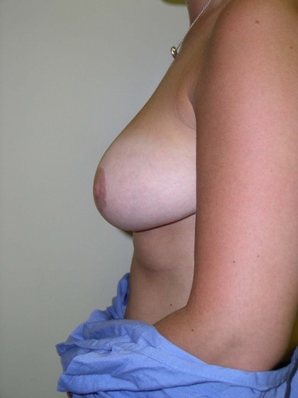 Breast Reduction Before & After Patient #229