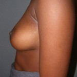 Breast Augmentation Before & After Patient #107