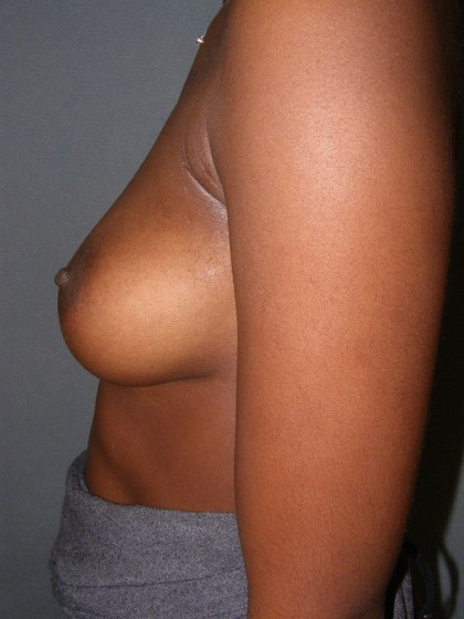 Breast Augmentation Before & After Patient #107
