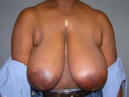 Breast Reduction Before & After Patient #244
