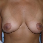 Breast Augmentation Before & After Patient #116