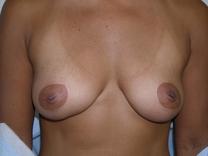Breast Augmentation Before & After Patient #116