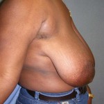 Breast Reduction Before & After Patient #244