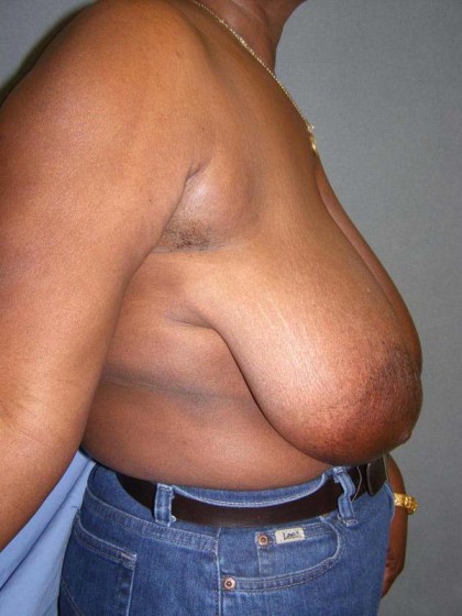 Breast Reduction Before & After Patient #244