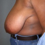 Breast Reduction Before & After Patient #244