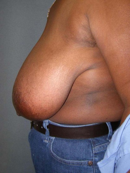 Breast Reduction Before & After Patient #244