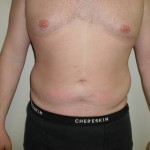Liposuction Before & After Patient #338