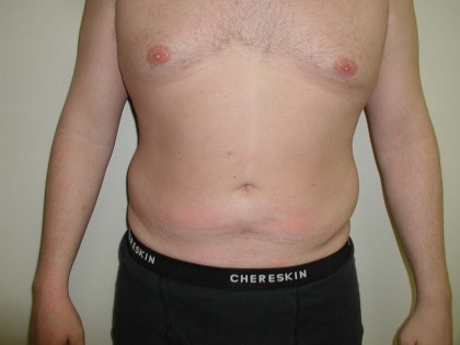 Liposuction Before & After Patient #338