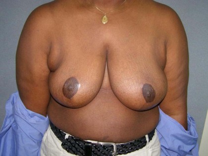 Breast Reduction Before & After Patient #244
