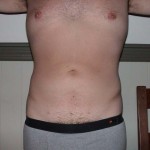 Liposuction Before & After Patient #338