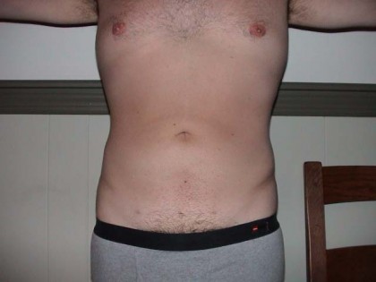 Liposuction Before & After Patient #338