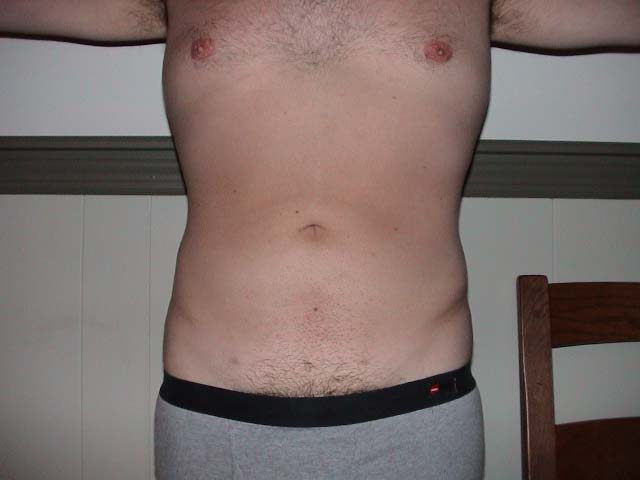 Liposuction Before & After Patient #338