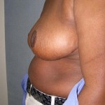 Breast Reduction Before & After Patient #244