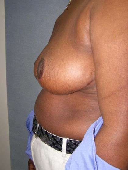 Breast Reduction Before & After Patient #244