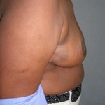Breast Reduction Before & After Patient #244