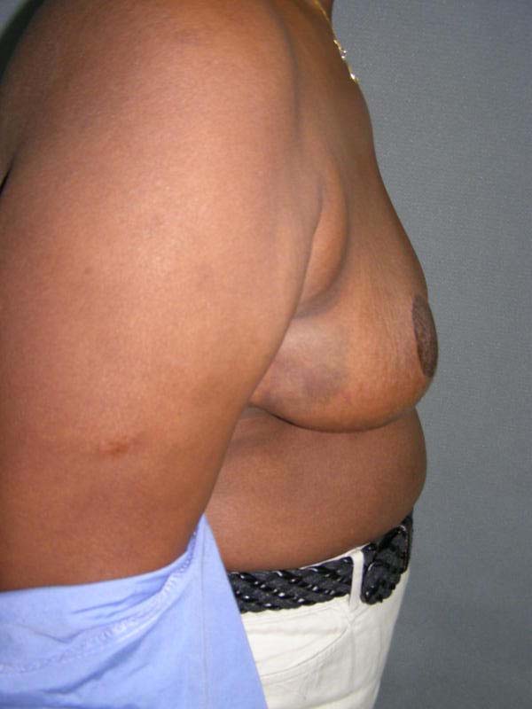 Breast Reduction Before & After Patient #244
