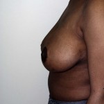 Breast Reduction Before & After Patient #252