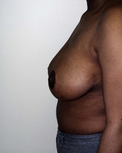 Breast Reduction Before & After Patient #252