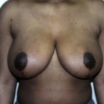 Breast Reduction Before & After Patient #252