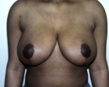 Breast Reduction Before & After Patient #252