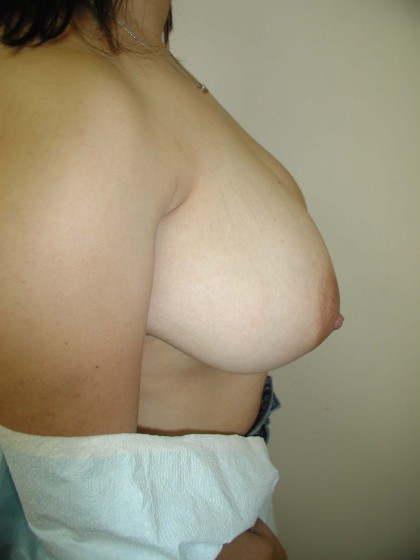 Breast Reduction Before & After Patient #257