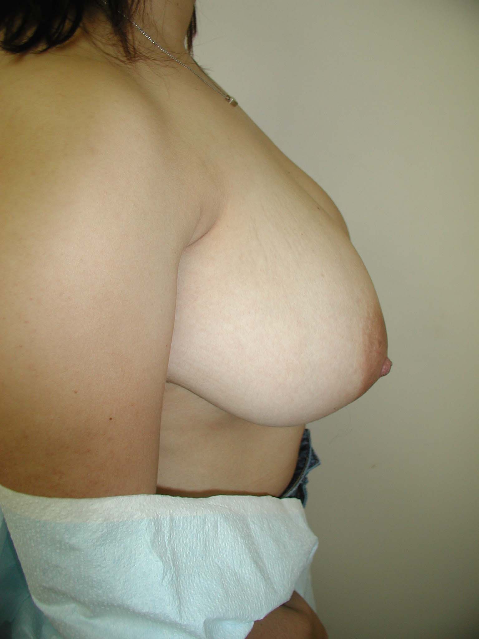 Breast Reduction Before & After Patient #257