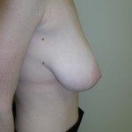 Breast Reduction Before & After Patient #269