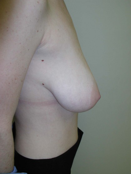 Breast Reduction Before & After Patient #269