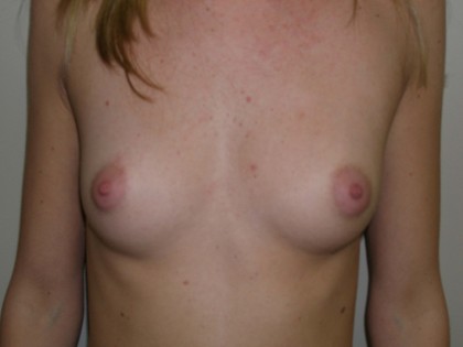 Breast Augmentation Before & After Patient #132